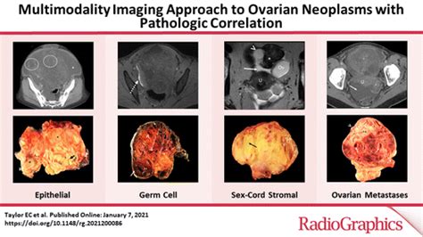 Multimodality Imaging Approach To Ovarian Neoplasms With Pathologic Correlation Radiographics