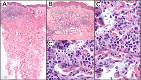 Histopathology Of Skin Punch Biopsies Obtained From Left Leg And Back