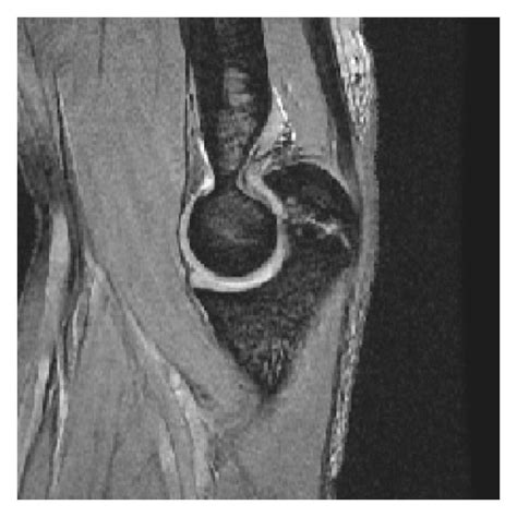 Sagittal T1 Weighted A And T2 Weighted B Magnetic Resonance Mr