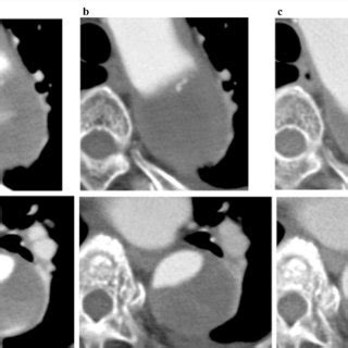 Preoperative Computed Tomography Preoperative Computed Tomography