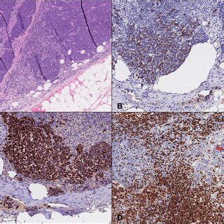 Sox Ck And Pax Expression In Merkel Cell Carcinoma Mcc