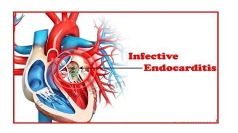 Infective Endocarditis Ppt