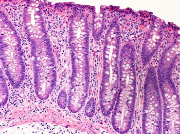 My Gastro Room: Microscopic colitis