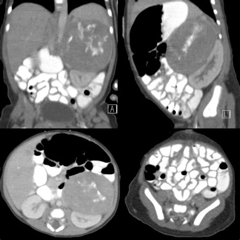 Newborn With A Left Abdominal Mass And Palpable Subcutaneous Nodules On