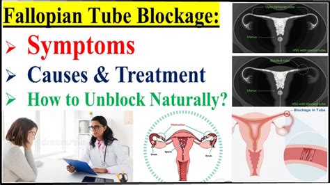 Fallopian Tube Blockage Symptoms Causes Diagnosis Treatment How To