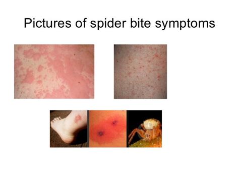 Spider Bites Pictures And Symptoms