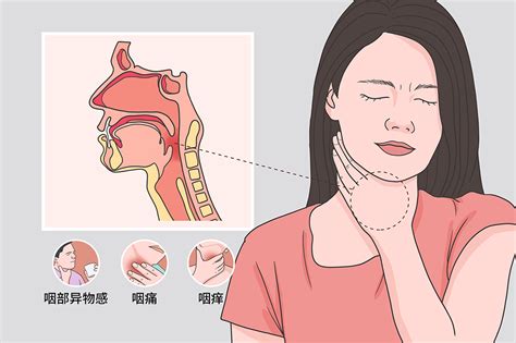 滤泡性咽炎 有来医生