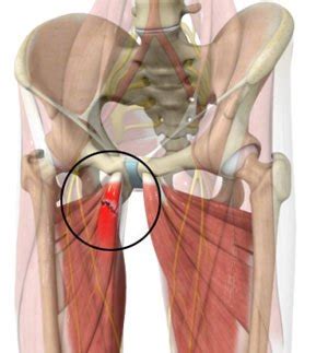 Adductor Tendon Repair | Mr Patrick Carton | Orthopaedic Surgeon ...