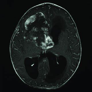 Axial T Weighted Magnetic Resonance Image Post Contrast Demonstrating