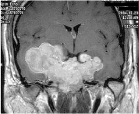 Giant invasive pituitary prolactinoma with falsely low serum PRL (103... | Download Scientific ...