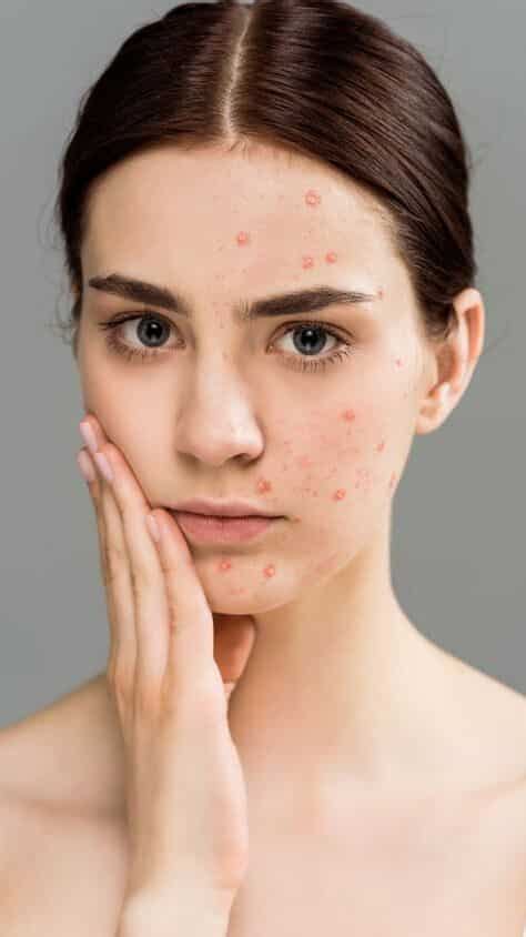 5 Tips To Avoid Hormonal Acne