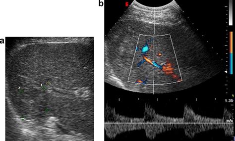 Contrast Enhanced Ultrasound In The Diagnosis Of Hepatocellular Carcinoma Journal Of Hepatology