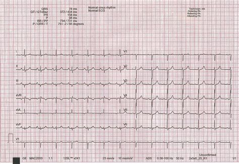 Das Ruhe Ekg Ablauf Bedeutung Und Auswertung