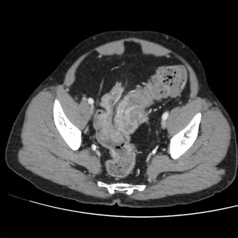 Sigmoid Colocolic Intussusception Image