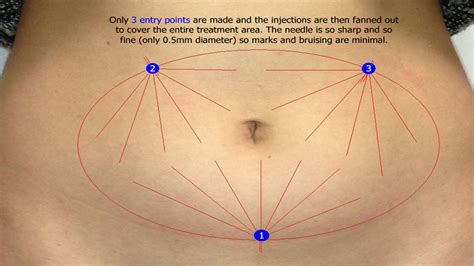 Stomach Aqualyx Fat Dissolving Injections Before And After