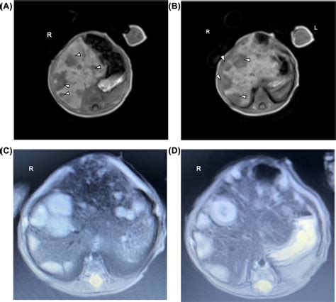 Coronal T1 Weighted Magnetic Resonance Imaging Mri A B Coronal