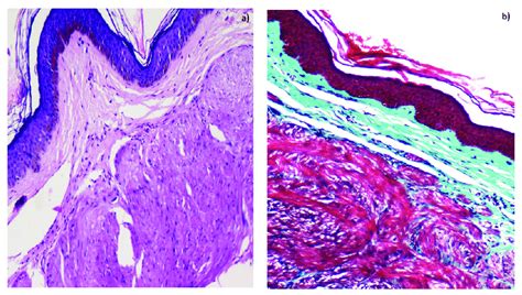 A Photomicrograph Showing Well Circumscribed Dermal Tumor Composed Of