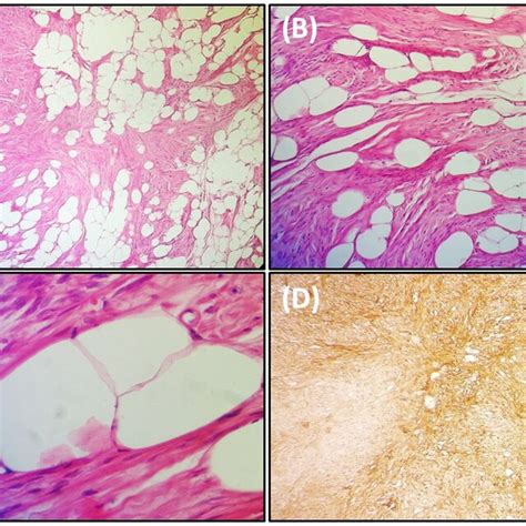 A Lipoleiomyoma Characterized By Bundles Of Fusiform Smooth Muscle Download Scientific