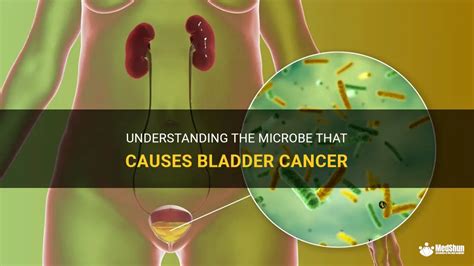 Understanding The Microbe That Causes Bladder Cancer Medshun