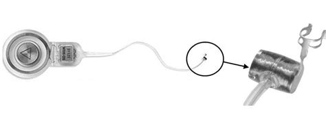 The Vibrating Ossicular Prosthesis An Internal Part Of Thevsb Download Scientific Diagram