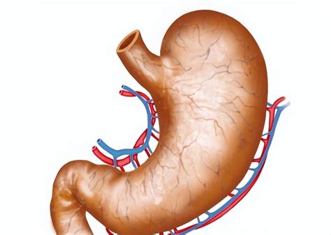 Bile Reflux Gastritis Should Not Be Underestimated It Is A Risk Factor