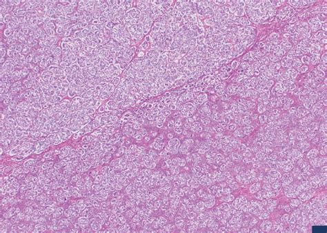 Nests Of Tumor Cells Intersected By Fibrous Septa A The Septa Were