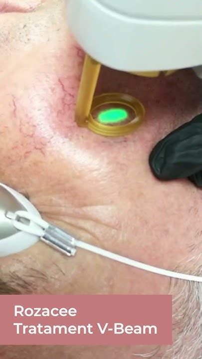 Tratament Rozacee Laser V Beam Clinica Medispa Youtube