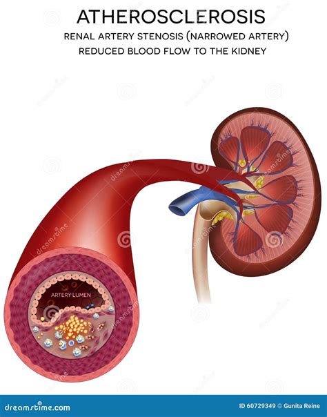 Kidney Artery Disease Stock Vector Illustration Of Cardiovascular