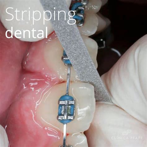 El Stripping Dental En Ortodoncia Cl Nica Dental En Barcelona