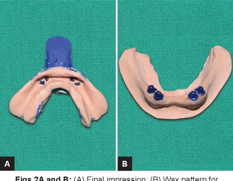 Figure 2 From Mandibular Tooth Supported Overdenture Using Customized