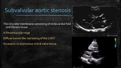 Echocardiography Of Aortic Stenosis