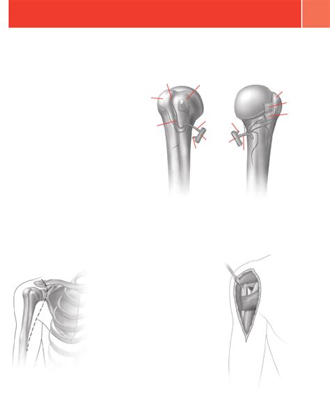 Zimmer Periarticular Proximal Humeral Locking Plate Surgical Technique