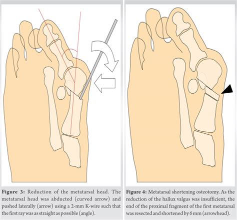 Distal Metatarsal And Proximal Phalangeal Osteotomies Without Soft Tissue Procedure For Hallux