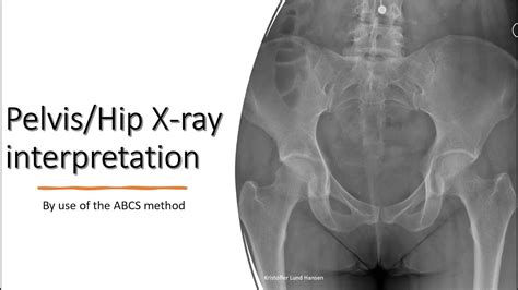 Pelvis Hip X Ray Interpretation Youtube