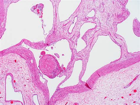 Recanalized Large Elastic Pulmonary Artery End Stage Of Co Flickr