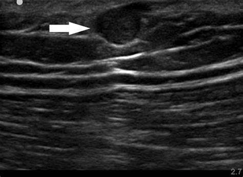 Gray Scale Ultrasonography Demonstrates A 08 × 06 Cm2 Sized Nodule