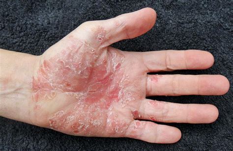 Psoriasis Vs Tinea Versicolor Causes Symptoms And Treatments