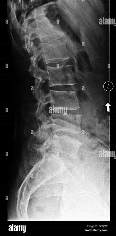 X Ray Showing Degenerative Disc Disease At Lumbar Vertebrae L