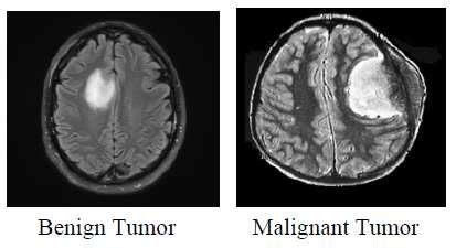 illustrations  benign  malignant brain image
