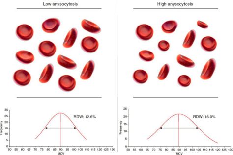 What is Anisocytosis - Definition, Causes and Treatment