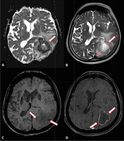 Mri Demonstrates Left Parieto Occipital Space Occupying Lesion On Dwi