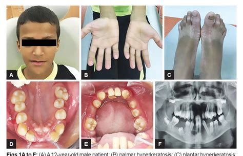 PDF Papillon Lefèvre Syndrome A Rare Case Report of Two Brothers and