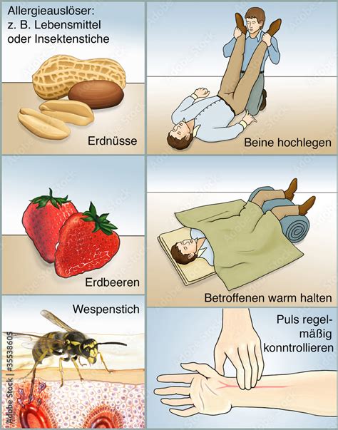 Allergischer Schock Auslöser Erste Hilfe Stock Illustration Adobe Stock