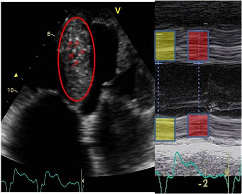 Typical Patterns Found In Echocardiographic Examinations In