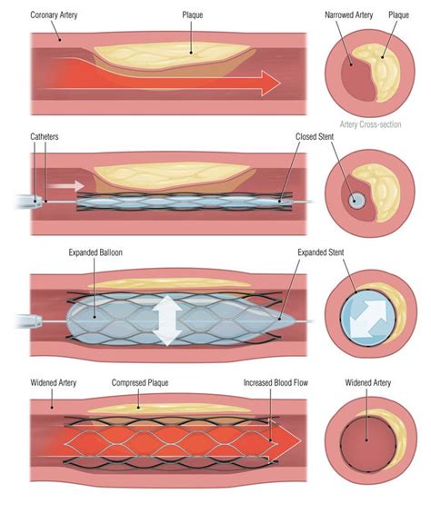 Angioplasty Guide