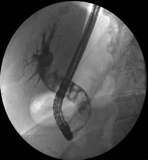 Cholangiography Dilated Common Bile Duct Up To 20 Mm And Multiple Download Scientific