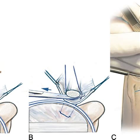 Arthroscopic Classification Of Radiocarpal Arthrosis For Scapholunate