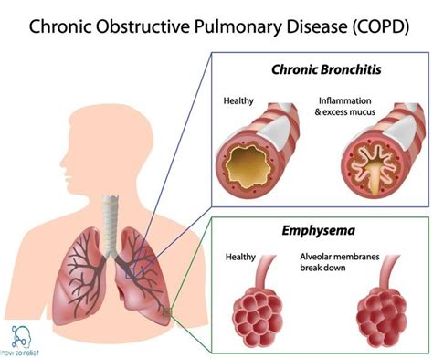 COPD : Symptoms, Causes, Types, Prevention & Treatment » How To Relief