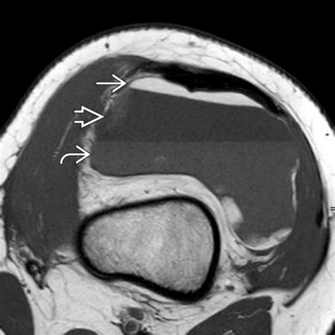 Hemarthrosis And Lipohemarthrosis Radiology Key