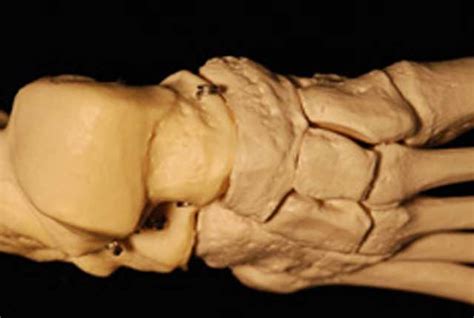 Foot Bones Allow Researchers To Determine Sex Of Skeletal Remains